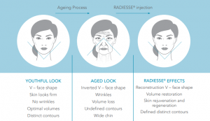 radiesse results 