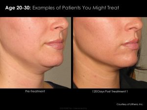 ultherapy